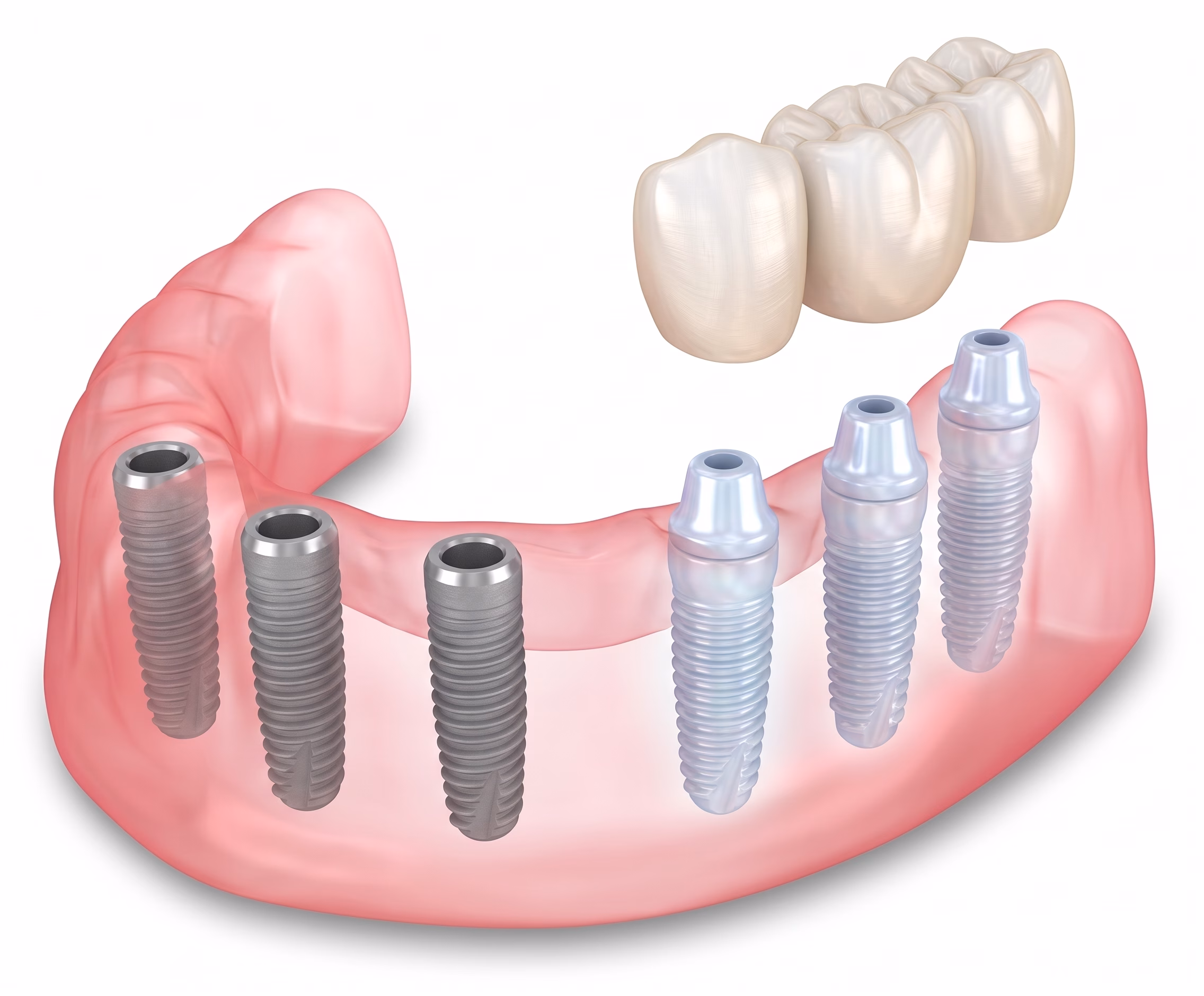 All On X Dental Implants